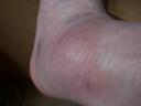 swollen_ankle.jpg